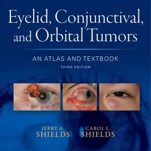 Eyelid, Conjunctival, and Orbital Tumors
